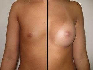 breast enlargement 