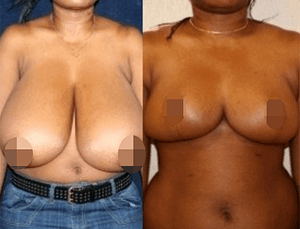 Before after results of a DC Breast Reduction