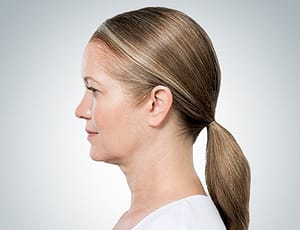 Kybella