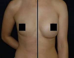 BREAST AUGMENTATION