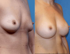 Breast Implants DC