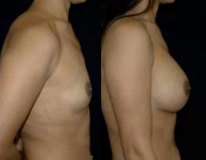 DC Breast Implants