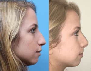 DC Rhinoplasty results, before after of a young girl
