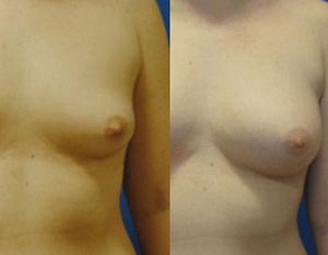Fat Grafting Breast Augmentation, DC