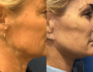 DC Facelift, Before and After