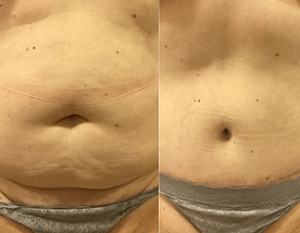 Example of Tummy Tuck Chevy Chase, before and after