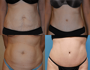 Tummy Tuck, before and afters