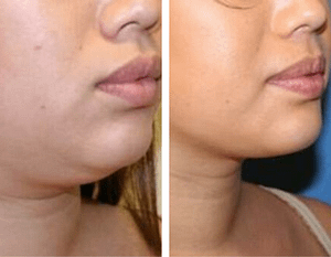 Chin lipo before and after