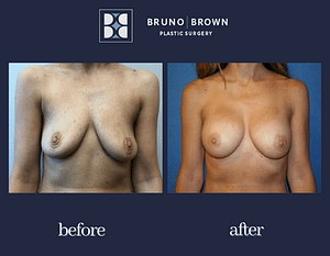 Before and after breast augmentation northern VA