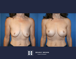 before and after breast augmentation of a middle age women