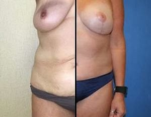 mommy makeover