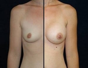 DC Breast implants