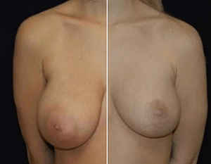 breast reduction