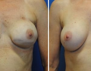 breast reconstructions, before and after image