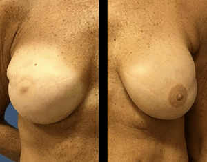 Prepectoral breast reconstruction results