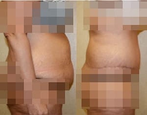 Before after DC tummy tuck surgery at Bruno Brown