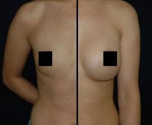DC Breast implant