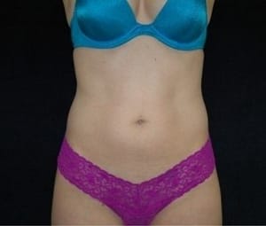 Laser Lipo