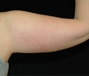 Laser Lipo
