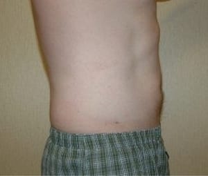 Laser Lipo