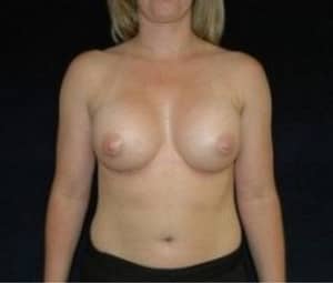 DC Breast Augmentation