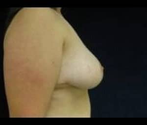 Breast reduction after
