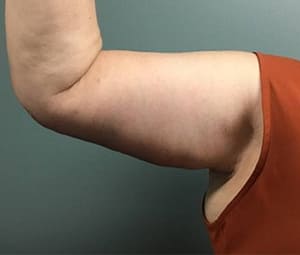 Arm Lift After (Front of Arm)