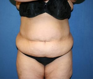 Tummy tuck front before