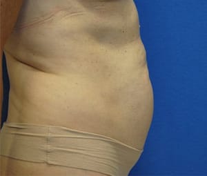 Tummy tuck side before