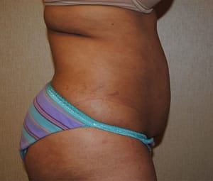 Tummy tuck side before