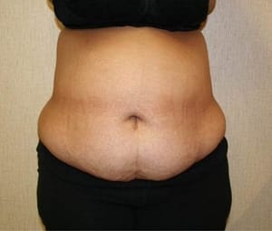 Tummy tuck front before