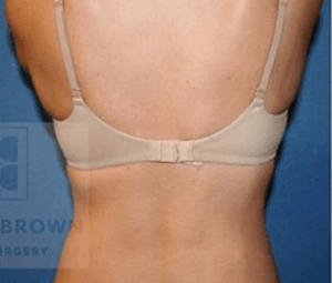 Laser Lipo