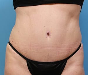 Tummy tuck front after