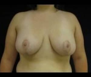 Breast reduction after