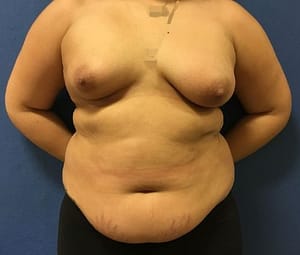 Before Breast Augmentation with Fat Grafting