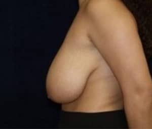 Breast reduction before
