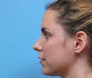 Rhinoplasty