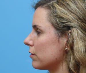 Rhinoplasty
