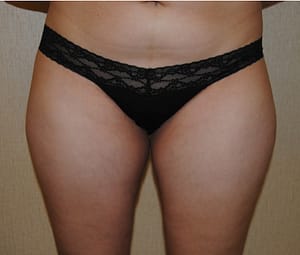 Before an Outer Thigh & Waistline Liposuction