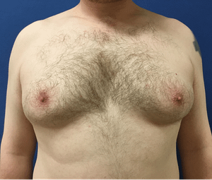Man before receiving lipo for his chest