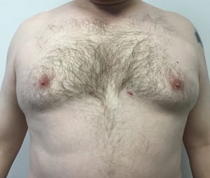 Man after receiving lipo for his chest