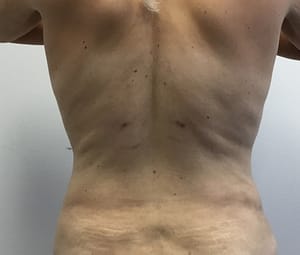 After DC Tummy Tuck & Back Liposuction