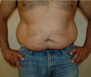 Middle aged man before receiving lipo for abs and love handles