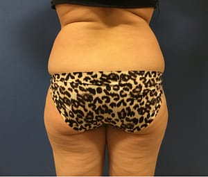 Middle aged woman before receiving lipo for love handles