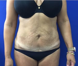 Plastic surgery results for a woman's tummy