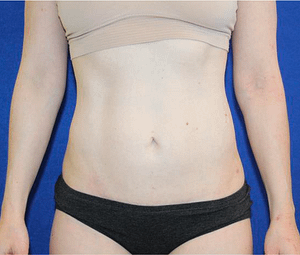 After picture liposuction (arms, abdomen, hips, flanks, and thighs) and lower abdominal skin excision (“mini tummy tuck”