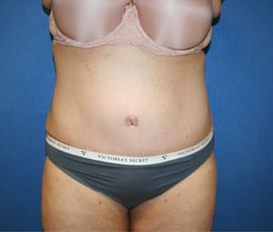 Tummy tuck front after