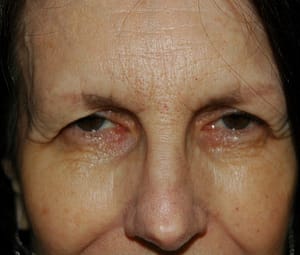 Blepharoplasty (Eyelid Surgery) DC