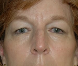 Blepharoplasty (Eyelid Surgery) DC