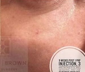 Microneedling w/ PRP Results